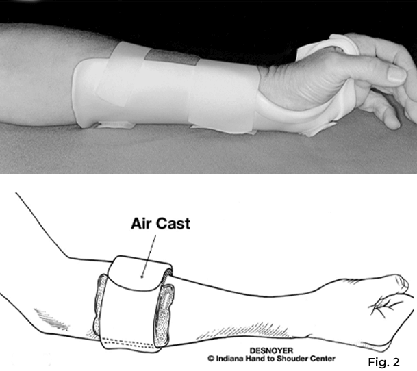 A tennis elbow band (air cast) provides pressure to the area and a splint that extends the wrist to relax the extensor muscles.