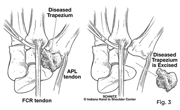 arthroplasty diagram