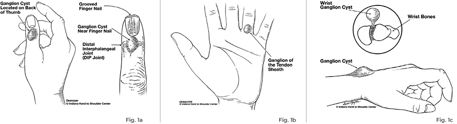 commonly encountered ganglion cysts diagram