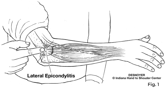 lateral epicondylitis