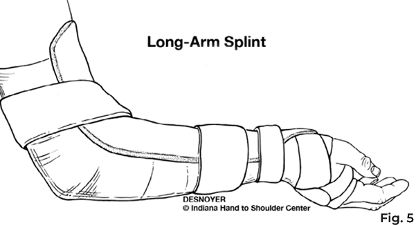 long arm splint