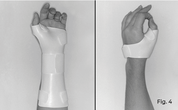 side by side of two splint types for thumb arthritis