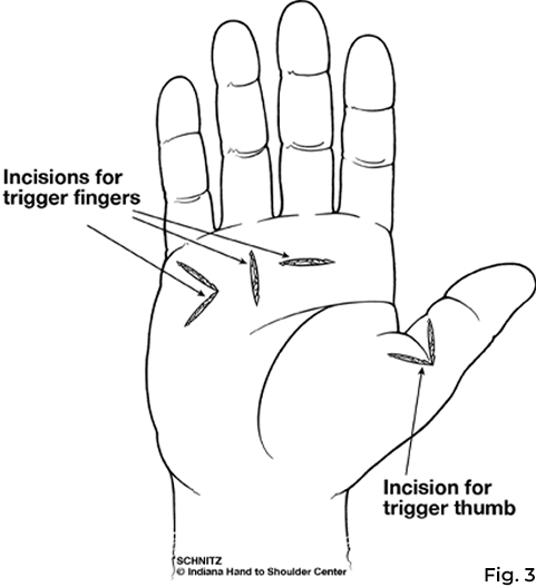 Possible incision sites for surgery to treat what is trigger finger