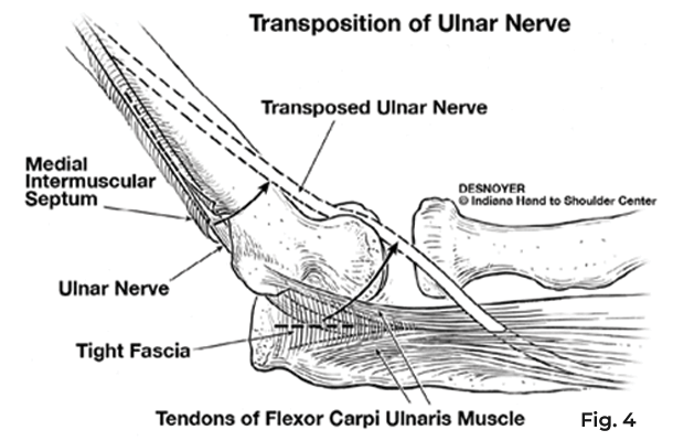 transposition of ulnar nerve