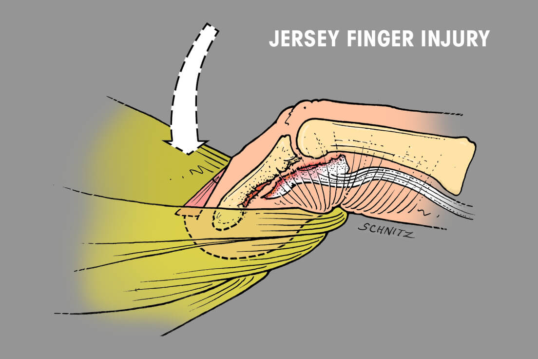 Chip Series de tiempo Desobediencia What is Jersey Finger (Flexor Tendon Rupture) | Indiana Hand to Shoulder  Center