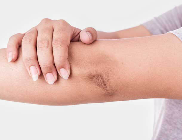 woman rubbing elbow who wants forearm pain relief