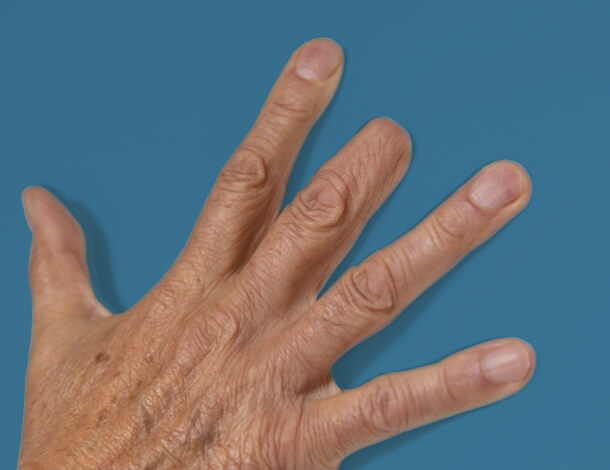 Hand with amputated finger experiencing phantom nerve pain.